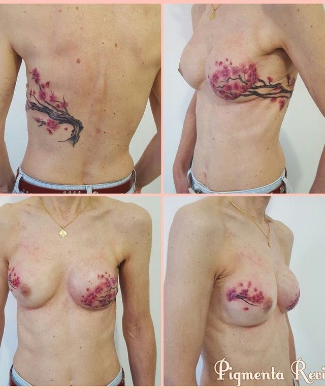 Tatuagem recupera autoestima da mulher após câncer de mama